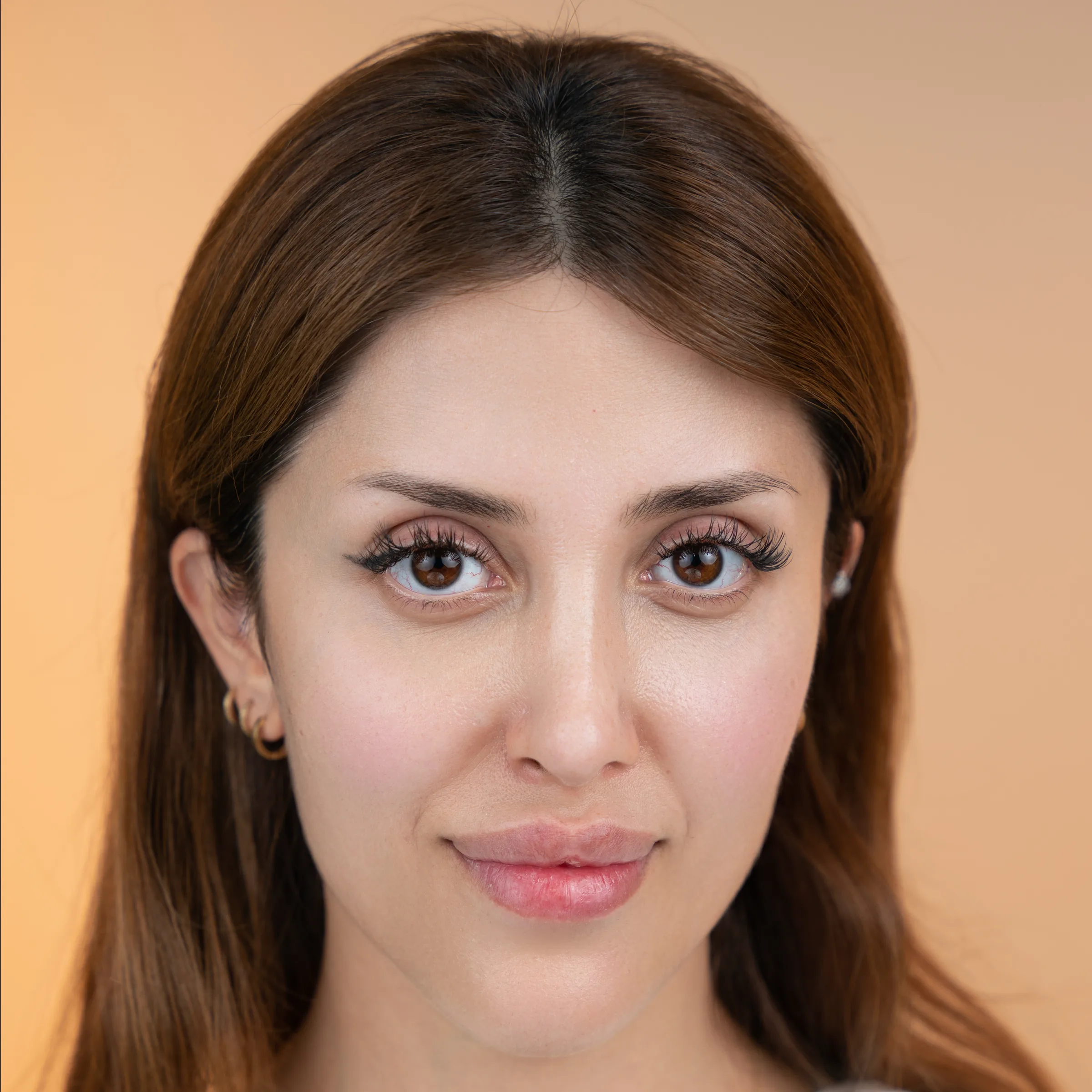Eyebrow transplant case one, second photo