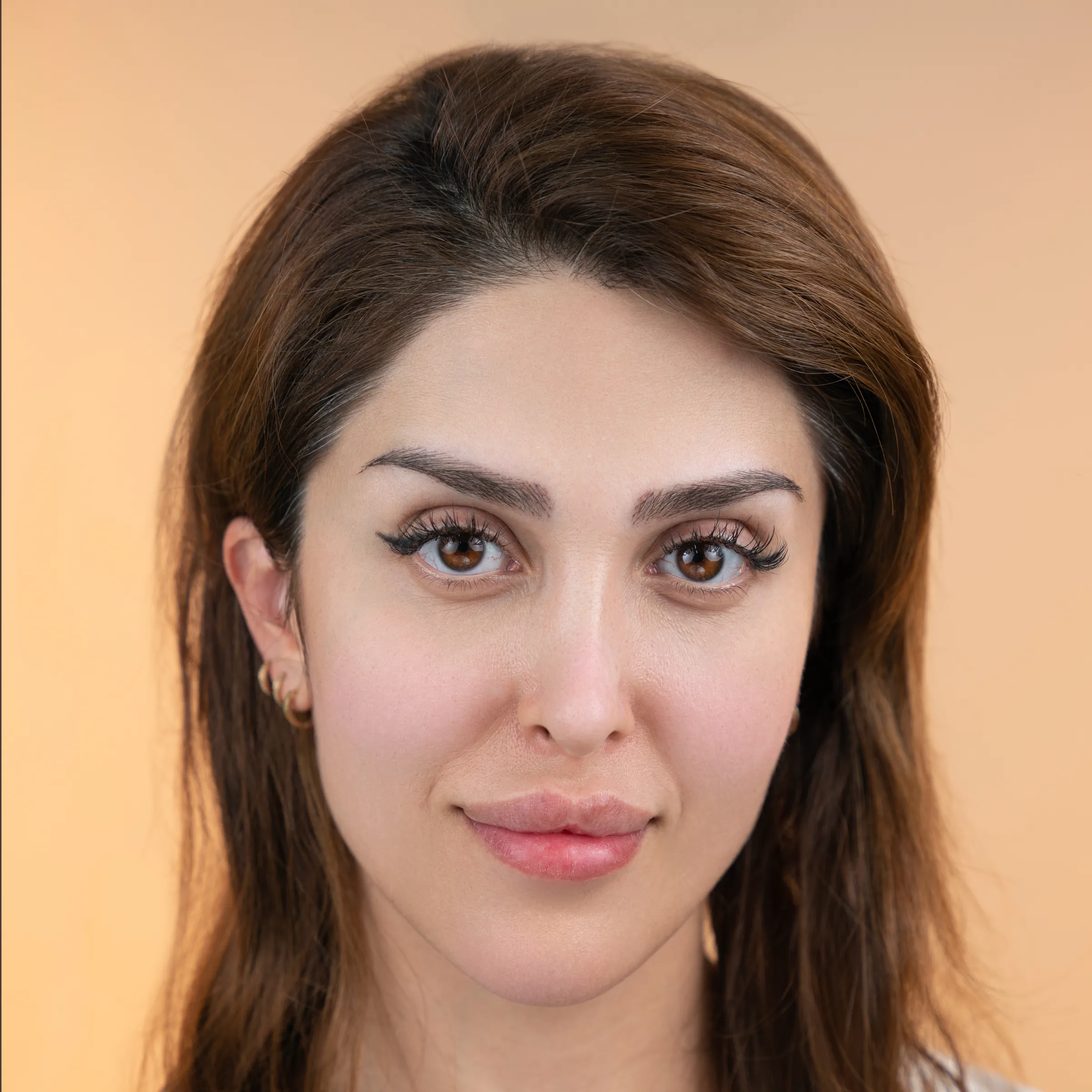 Eyebrow transplant case one, first photo