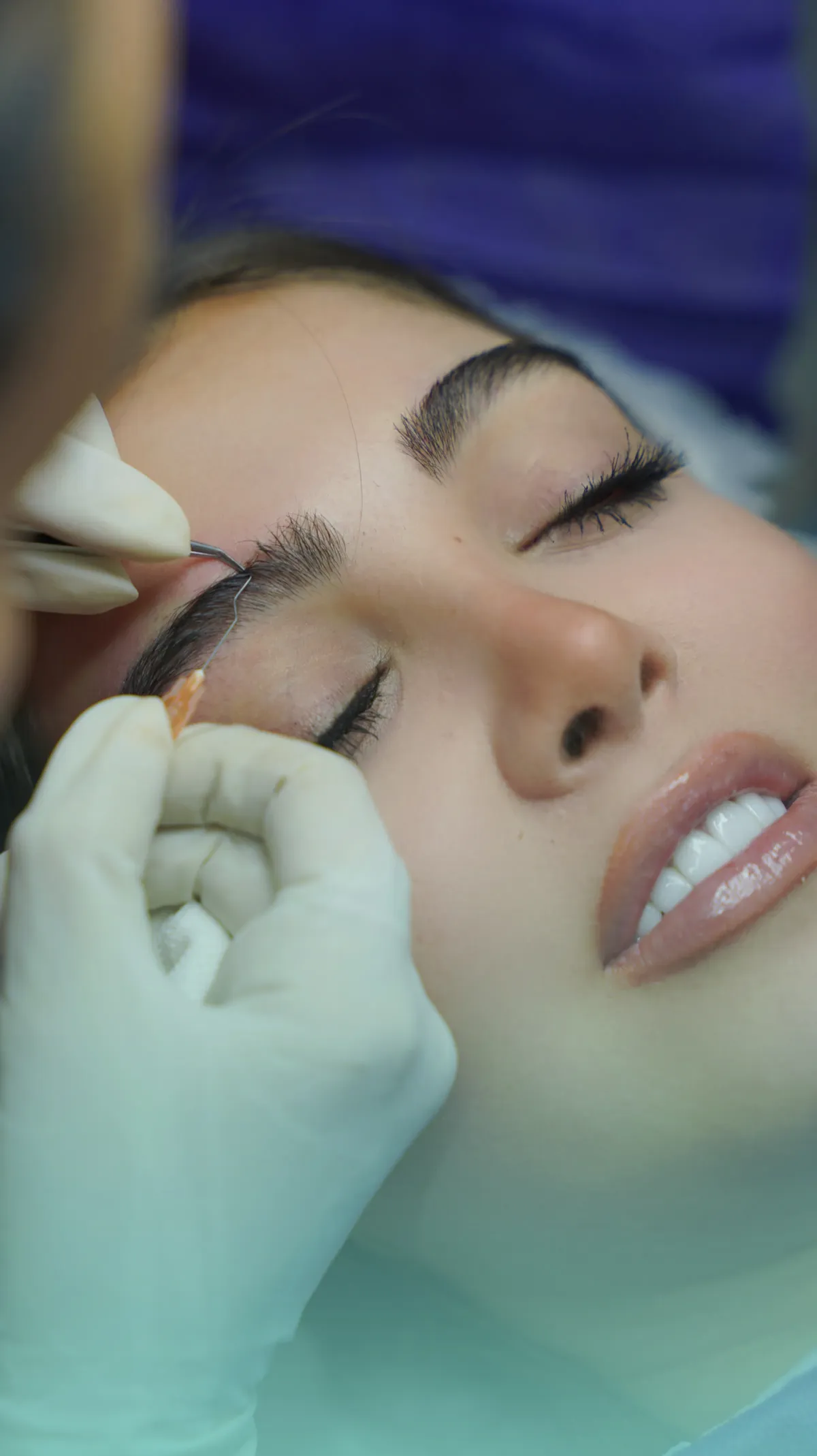 Eyebrow transplant result — Piko-Graft at KMA Poliklinik