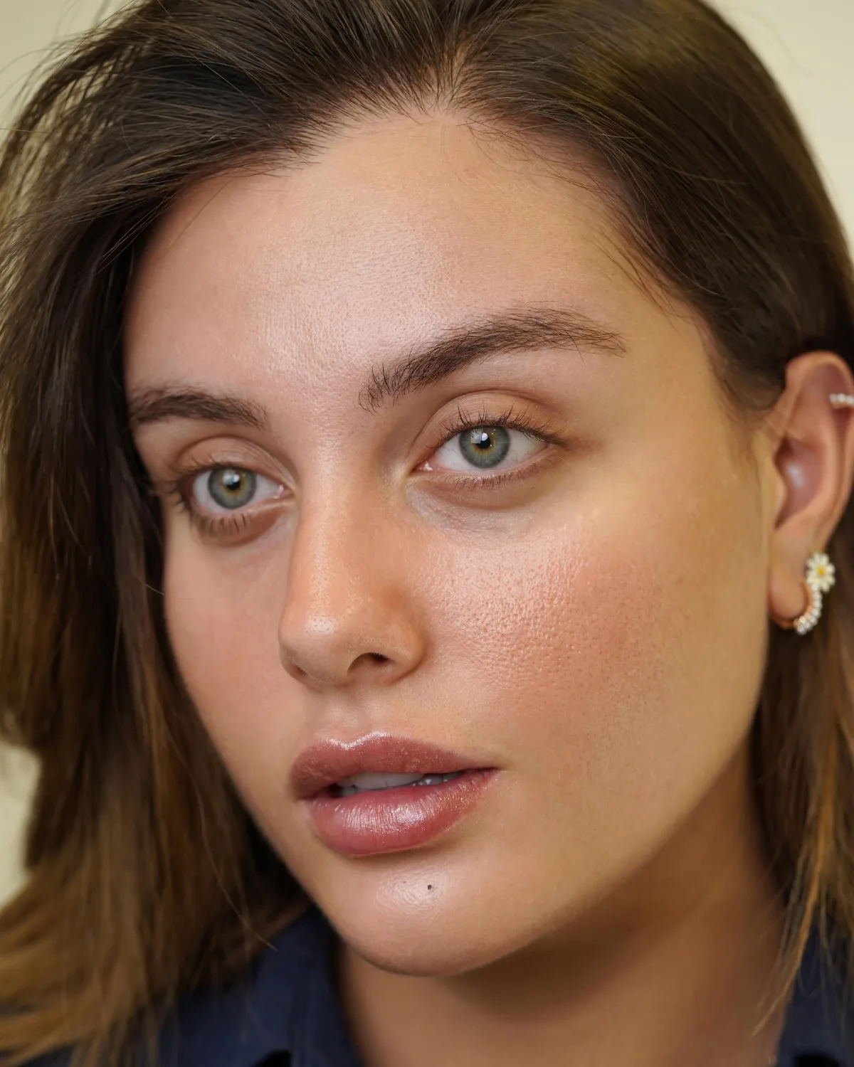 Eyebrow transplant case eight, second photo